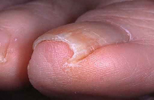 Ingrown Toenail Treatment Ingrown Toenail Treatment